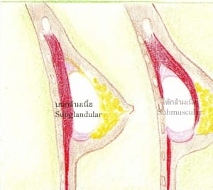 9-example silicone placement