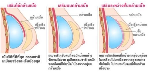 kbreast03