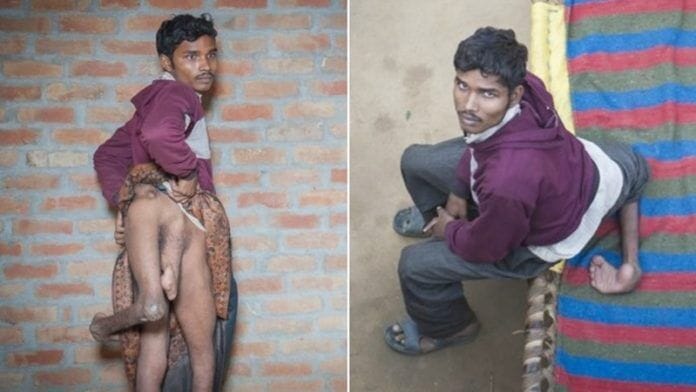 *** EXCLUSIVE - VIDEO AVAILABLE *** FARRUKHABAD, INDIA - DECEMBER 9: Arun Kumar Rajput shows his four legs at his house on December 9, 2015 in Farrukhabad, India. A YOUNG man with FOUR legs appealed to doctors to amputate his two extra limbs. Arun Kumar, 22, was born with two extra legs growing from his lower back - one underdeveloped and the other permanently bent at the knee. After living for 15 years without any kind of treatment, Arun, from Uttar Pradesh, India, appealed through social media for medical help to remove his extra legs. A team of specialists at Fortis Hospital in Delhi responded to Arunís plea for help and organised a series of tests to find out how the legs are attached and if he can be treated. **CONDITION OF USAGE: The following plug must be used in print and/or online: Arun's story appears in Body Bizarre, Thursday November 3, 10pm, on TLCî credit: TLC/ Barcroft Productions** PHOTOGRAPH BY Arkaprava Ghosh / Barcroft Images London-T:+44 207 033 1031 E:hello@barcroftmedia.com New York-T:+1 212 796 2458 E:hello@barcroftusa.com New Delhi-T:+91 11 4053 2429 E:hello@barcroftindia.com www.barcroftimages.com