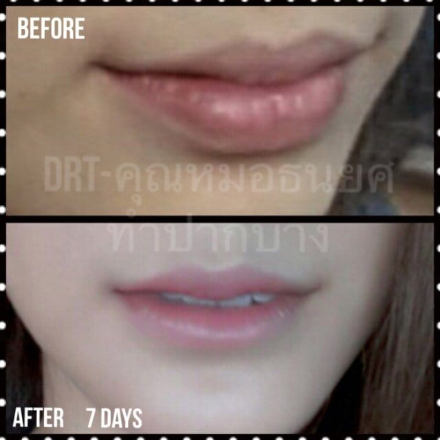 lipdrt06