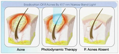 photodynamic