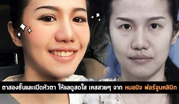 ตาสองชั้นและเปิดหัวตา