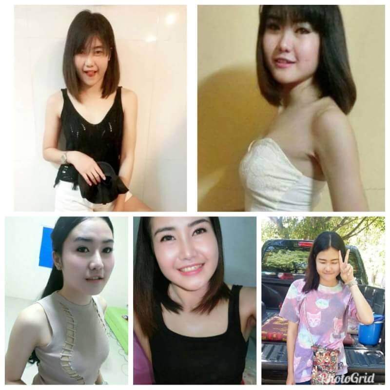 สาวเล่าเรื่องเสริมหน้าอก