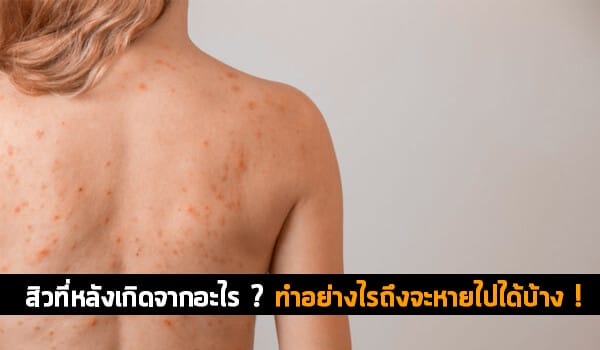 สิวที่หลังเกิดจากอะไร