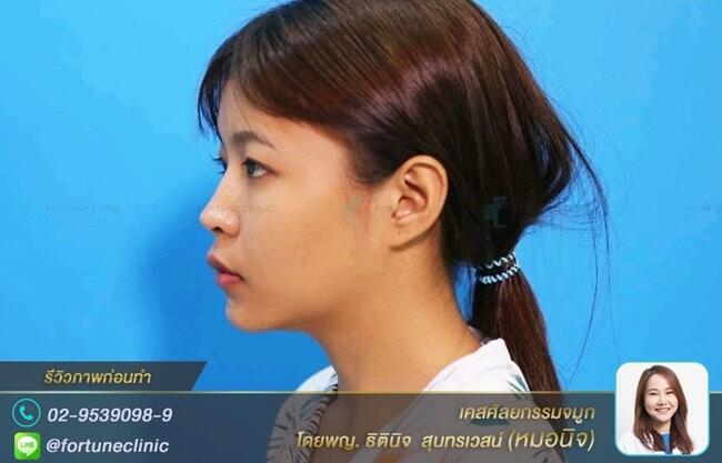 เสริมจมูกใหม่สไตล์เกาหลี