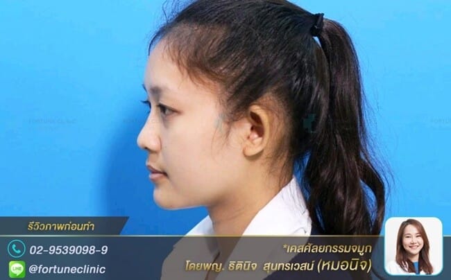 เสริมจมูกปลายกลมใหญ่