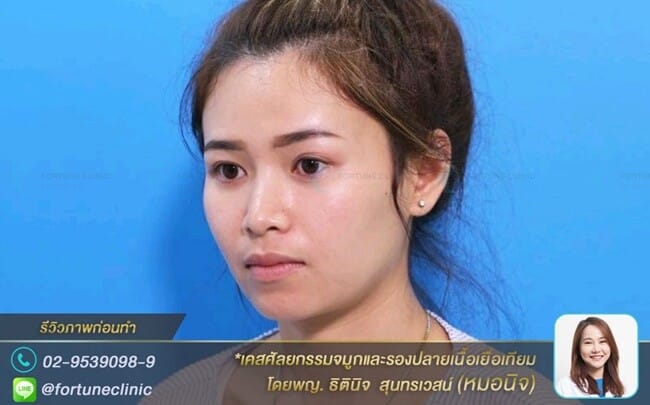 เสริมจมูกให้สันเรียวปลายสวย