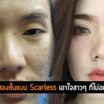 ศัลยกรรมตาสองชั้นแบบ Scarless