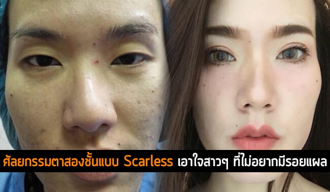 ศัลยกรรมตาสองชั้นแบบ Scarless