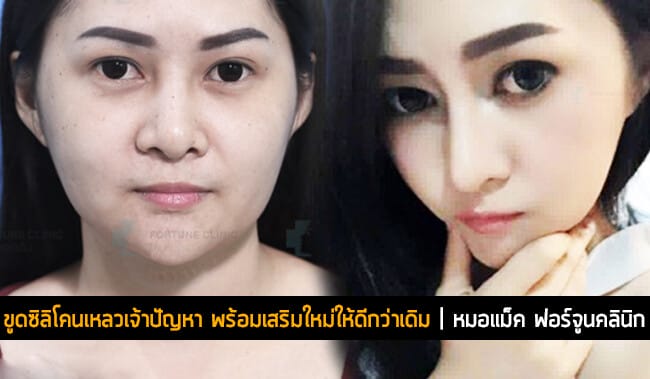 ขูดซิลิโคนเหลวเจ้าปัญหา