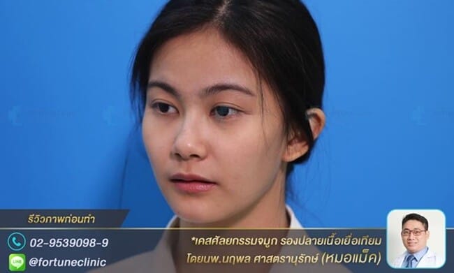 ปรับทรงจมูกให้ใบหน้าดูเรียวยาว