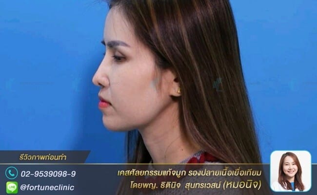 แก้จมูกปลายบางแดง