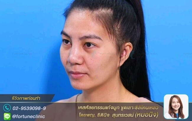 จมูกบวมใหญ่เพราะพิษซิลิโคนเหลว