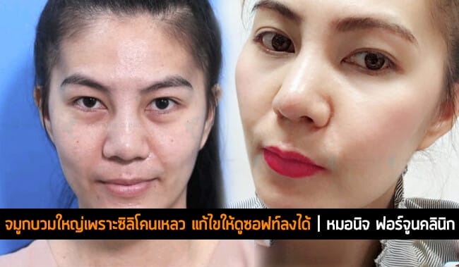 จมูกบวมใหญ่เพราะพิษซิลิโคนเหลว