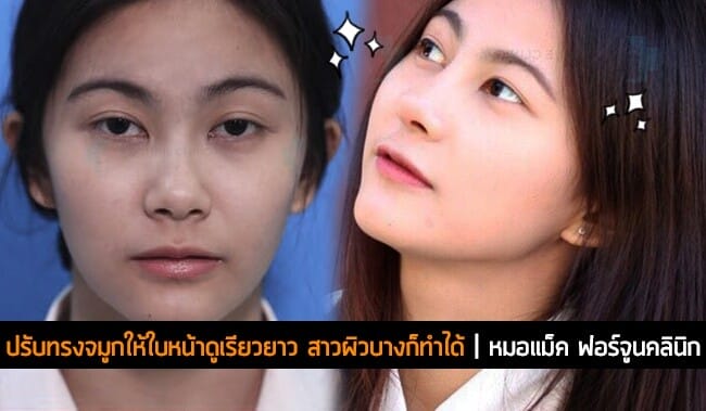 ปรับทรงจมูกให้ใบหน้าดูเรียวยาว