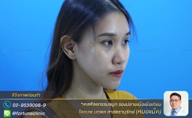 ปรับมิติให้จมูกเรียวสวยด้วยเนื้อเยื่อเทียม