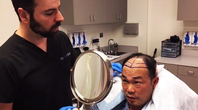 Long Hair Transplantation