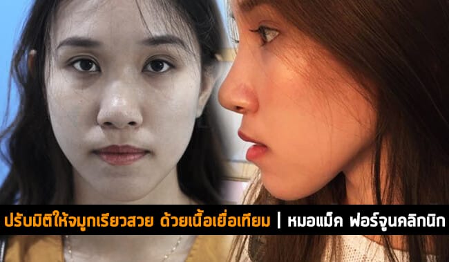 ปรับมิติให้จมูกเรียวสวยด้วยเนื้อเยื่อเทียม