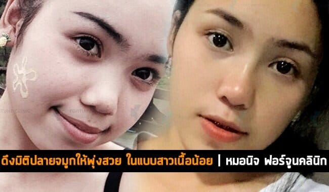 ดึงมิติปลายจมูกให้พุ่งสวย