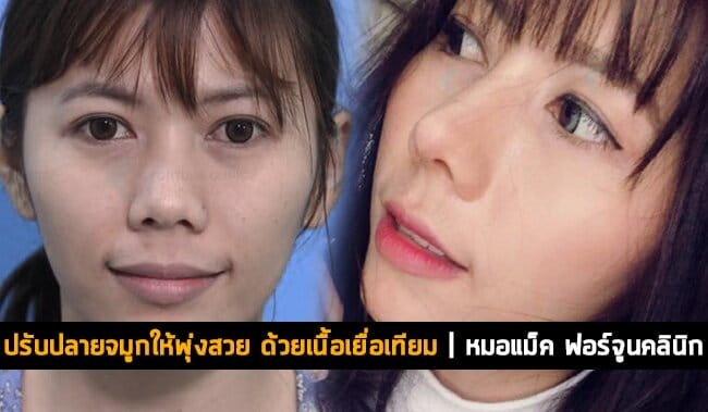 ปรับปลายจมูกให้พุ่งสวย