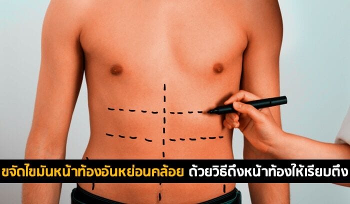 ขจัดไขมันหน้าท้องอันหย่อนคล้อย