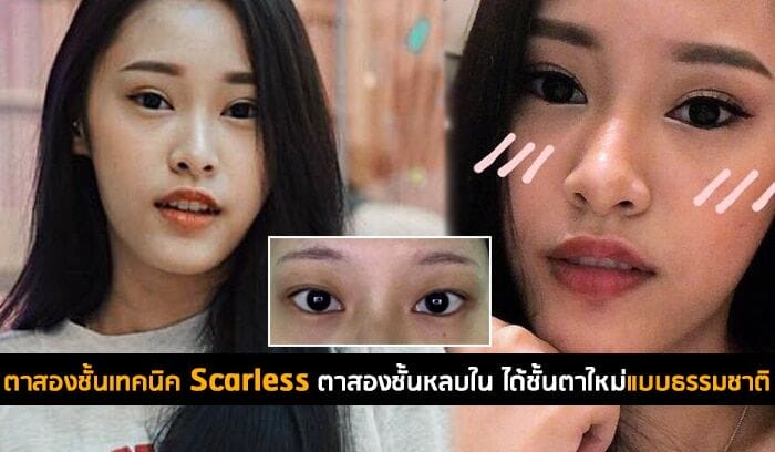 ตาสองชั้นเทคนิค Scarless