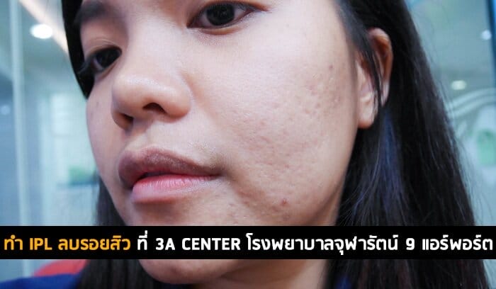 ทำ IPL ลบรอยสิว