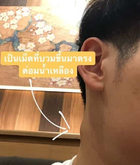 มะเร็งหลังโพรงจมูก