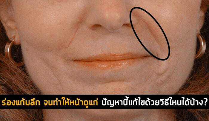 ร่องแก้มลึก