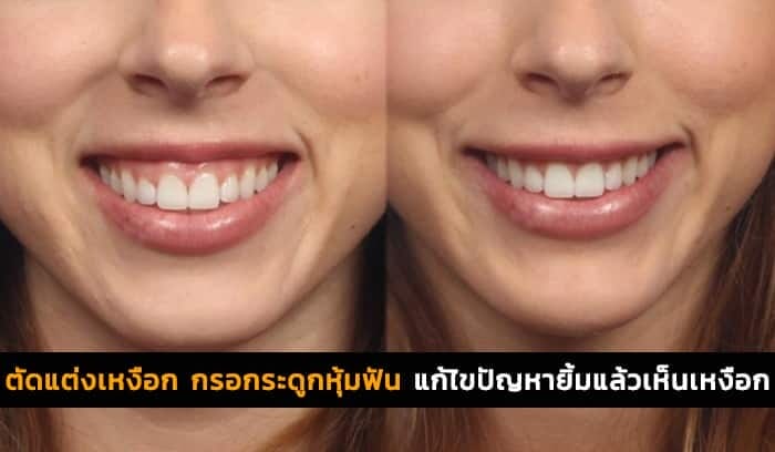 ยิ้มแล้วเห็นเหงือก