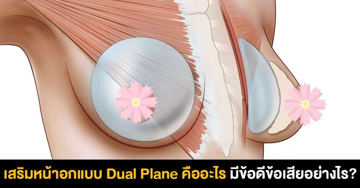 เสริมหน้าอกแบบ Dual Plane