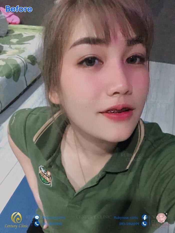 เสริมใบหน้าให้ละมุนนี