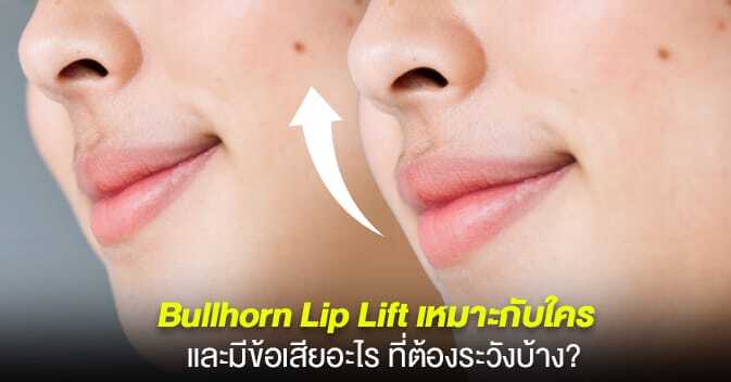 Bullhorn Lip Lift